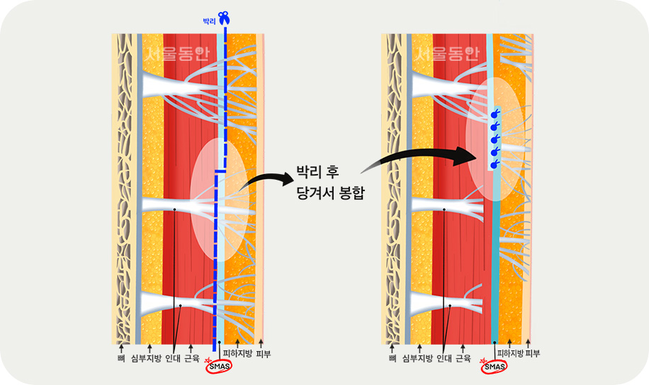 박리 후 당겨서 봉합