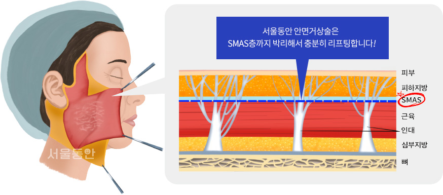 서울동안 안면거상술은 SMAS층까지 박리해서 충분히 리프팅합니다!