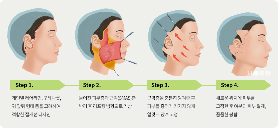 Step1. 개인별 헤어라인, 구레나룻, 귀 앞뒤 형태 등을 고려하여 적합한 절개선 디자인 > Step2. 늘어진 피부층과 근막(SMAS)층 박리 후 리프팅 방향으로 거상 > Step3. 근막층을 충분히 당겨준 후 피부를 흉터가 커지지 않게 알맞게 당겨 고정 > Step4. 새로운 위치에 피부를 고정한 후 여분의 피부 절제, 꼼꼼한 봉합