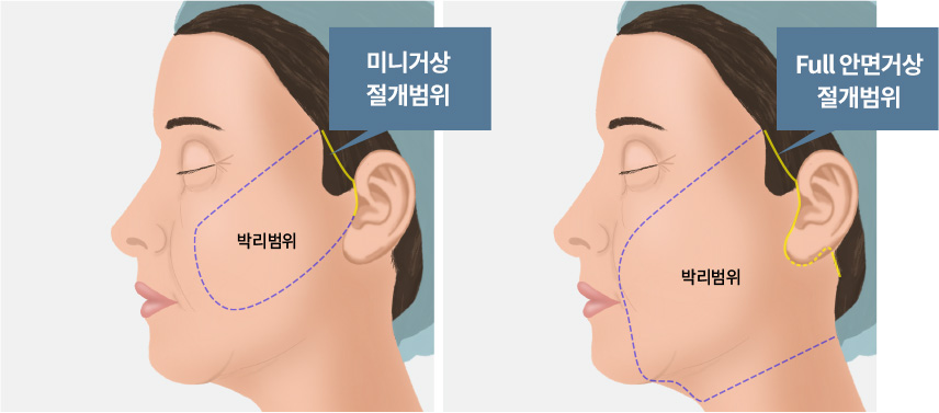 미니거상 절개범위 / Full 안면거상 절개범위