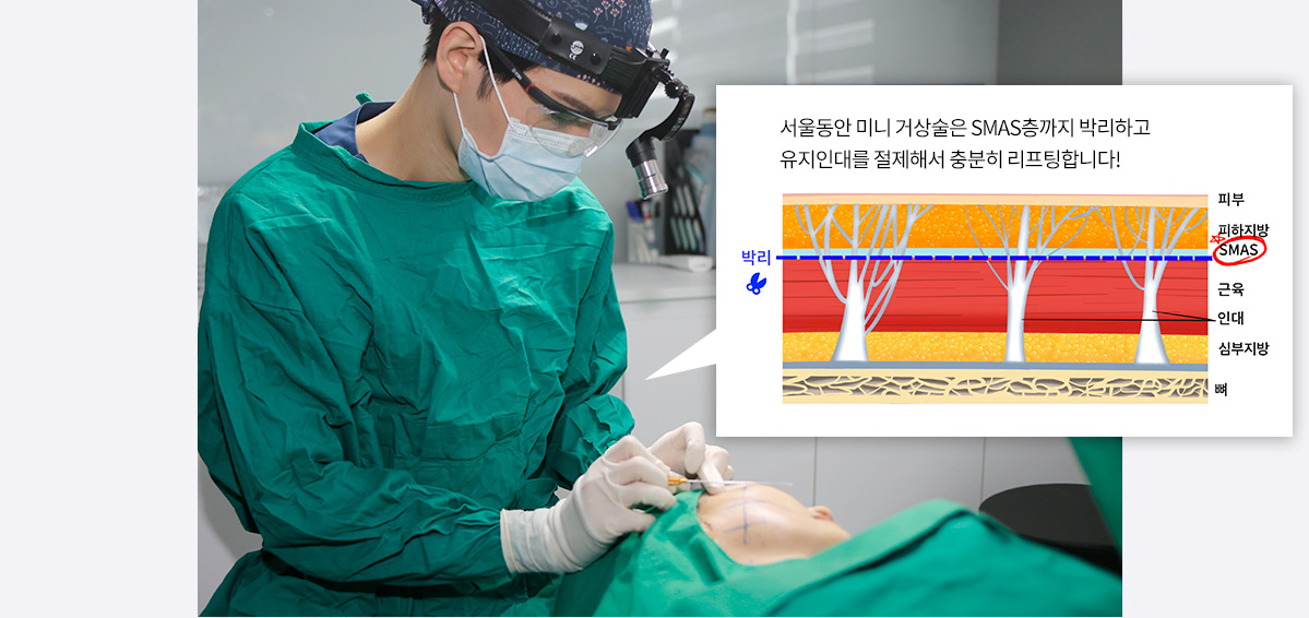 서울동안 미니 거상술은 SMAS층까지 박리하고 유지인대를 절제해서 충분히 리프팅합니다!